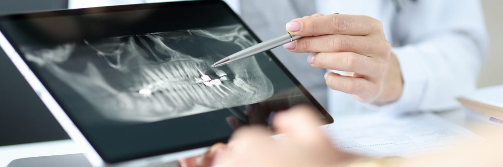 Zygomatic Implants