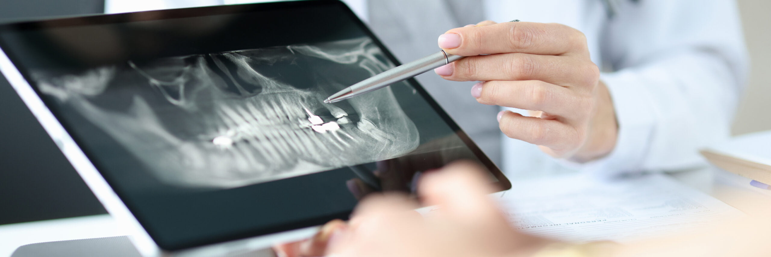 Zygomatic Implants