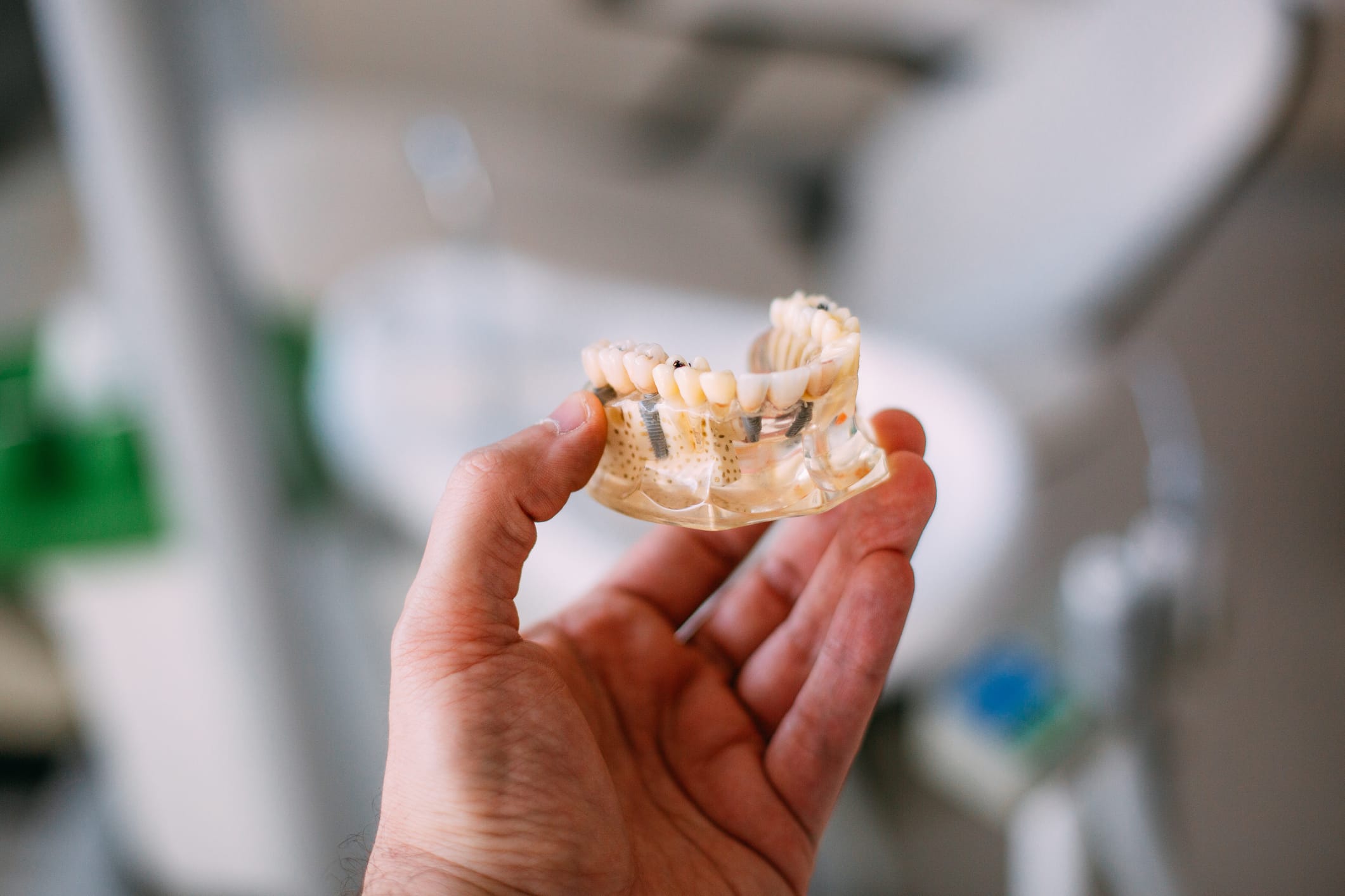 Implant-Supported Dentures
