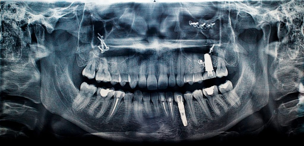 Sinus Lift and Dental Implants