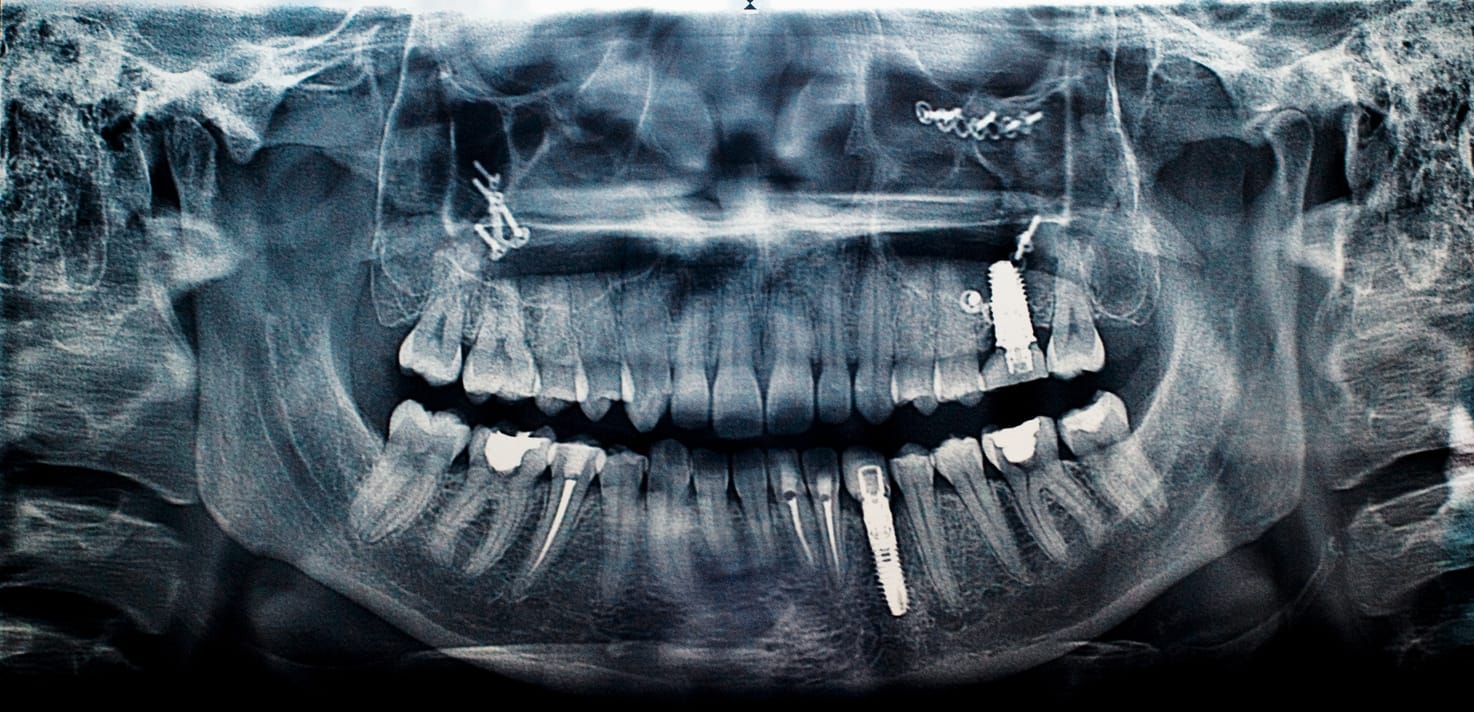 Sinus Lift and Dental Implants