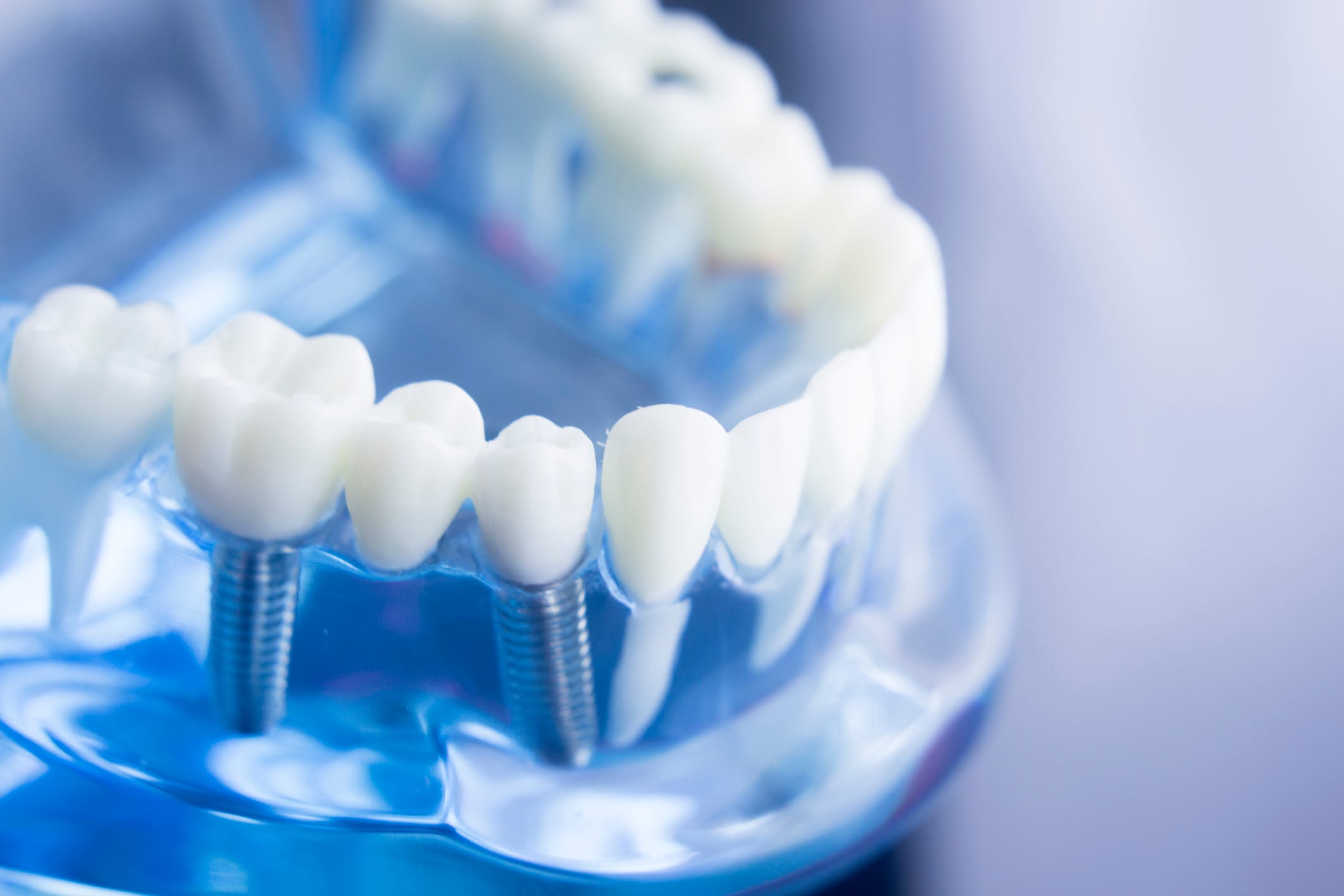 Zirconia vs. Titanium Implants