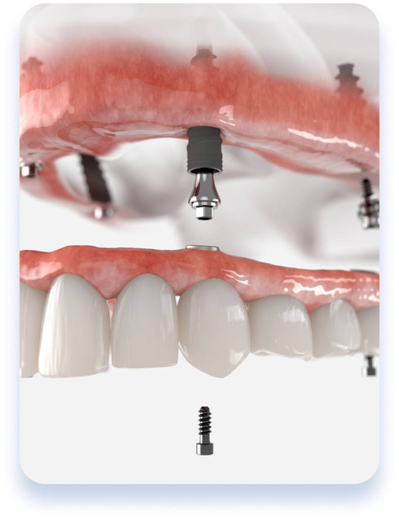 All-on-4 dental implants service illustration