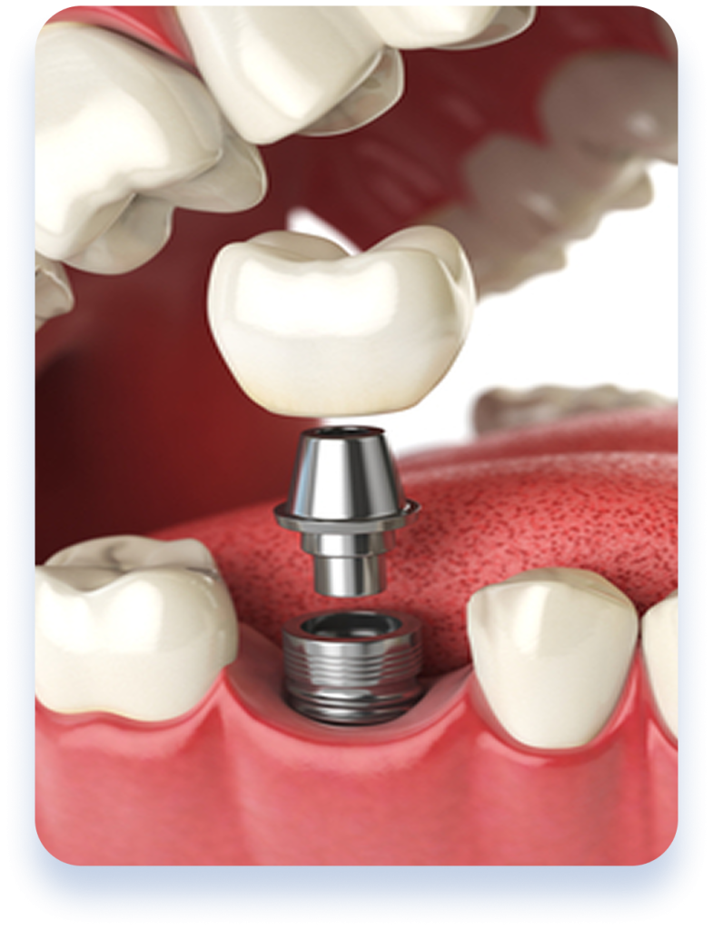 Dental implants service overview illustration