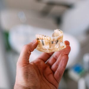 Implant-Supported Dentures