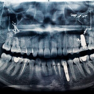 Sinus Lift and Dental Implants