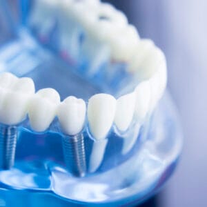 Zirconia vs. Titanium Implants